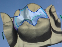 CEREC Inlay