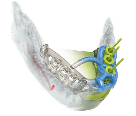 schablobe1100x53a